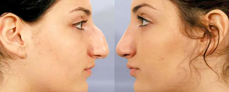 RHINOPLASTIE ESTHETIQUE 